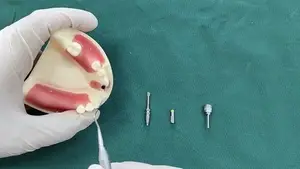 نظام الطبعة المفتوحة لزرعات الأسنان (open Tray)