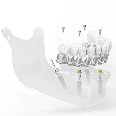 جسر الاسنان (CAD/CAM Framework)
